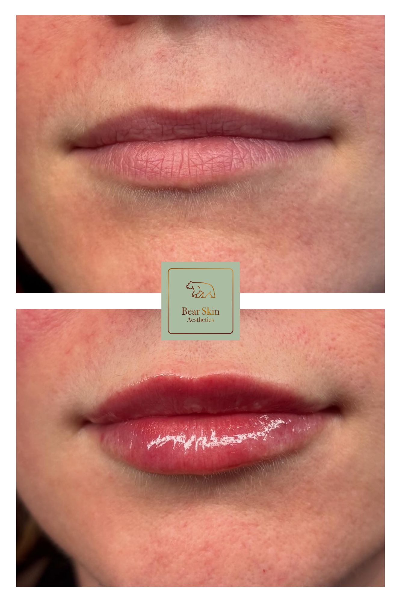 Before and after — Lip hydration & shape
