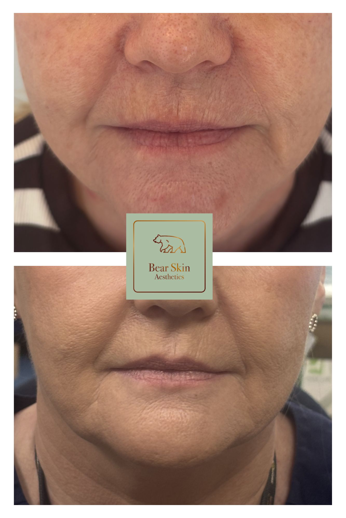 Before and after — Lip & perioral refresh