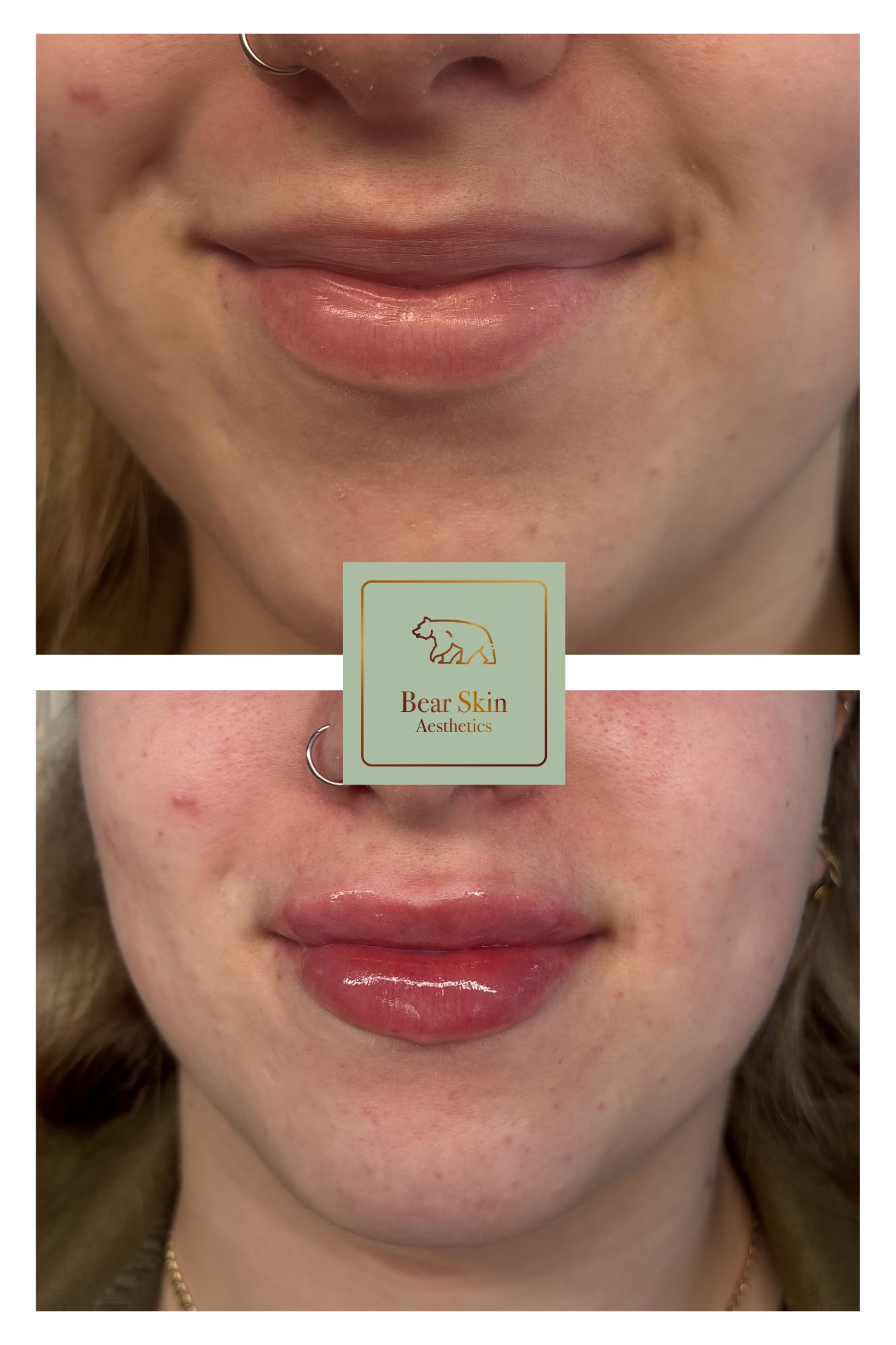 Before and after — Volume & definition