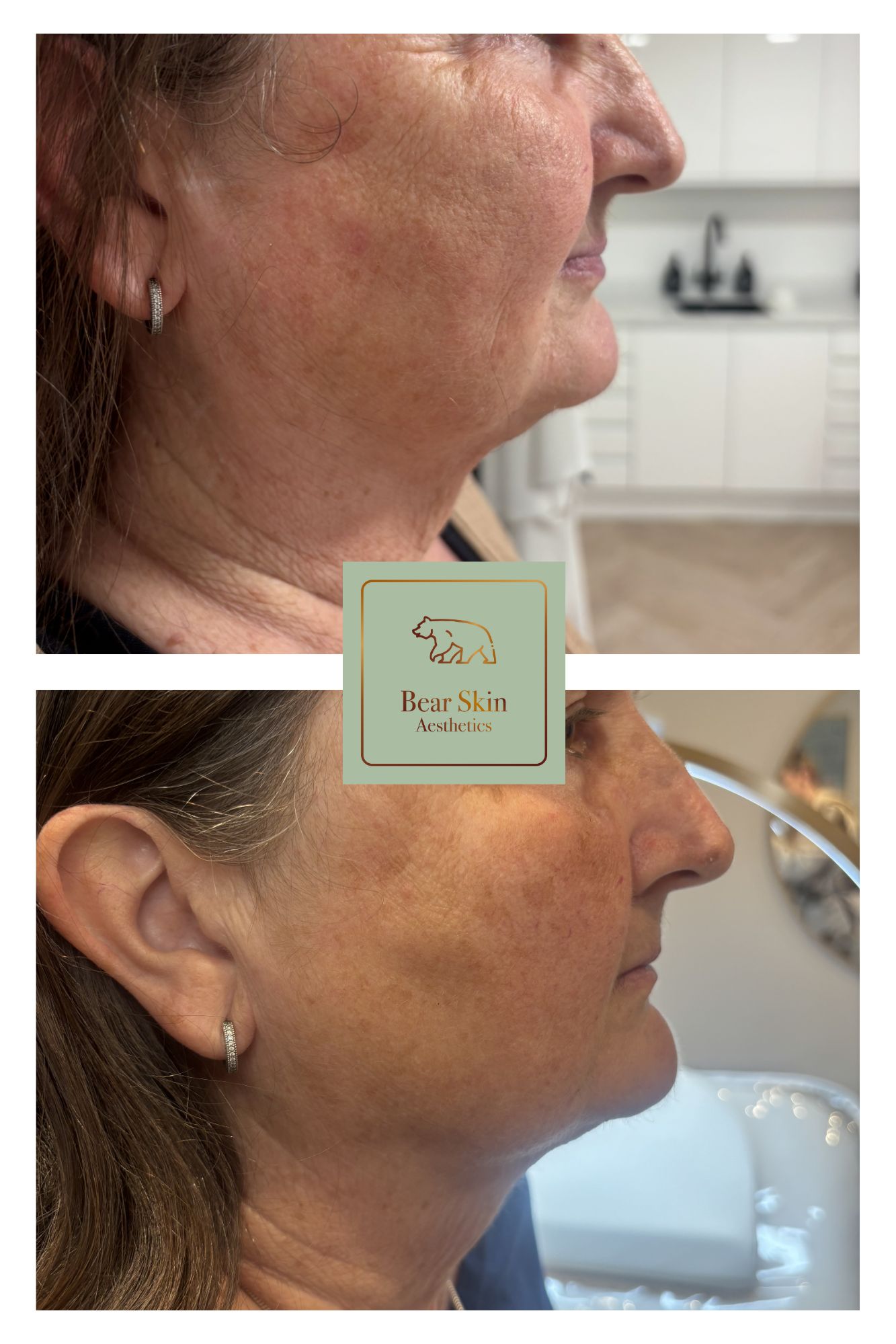 Before and after — Jawline & neck lift
