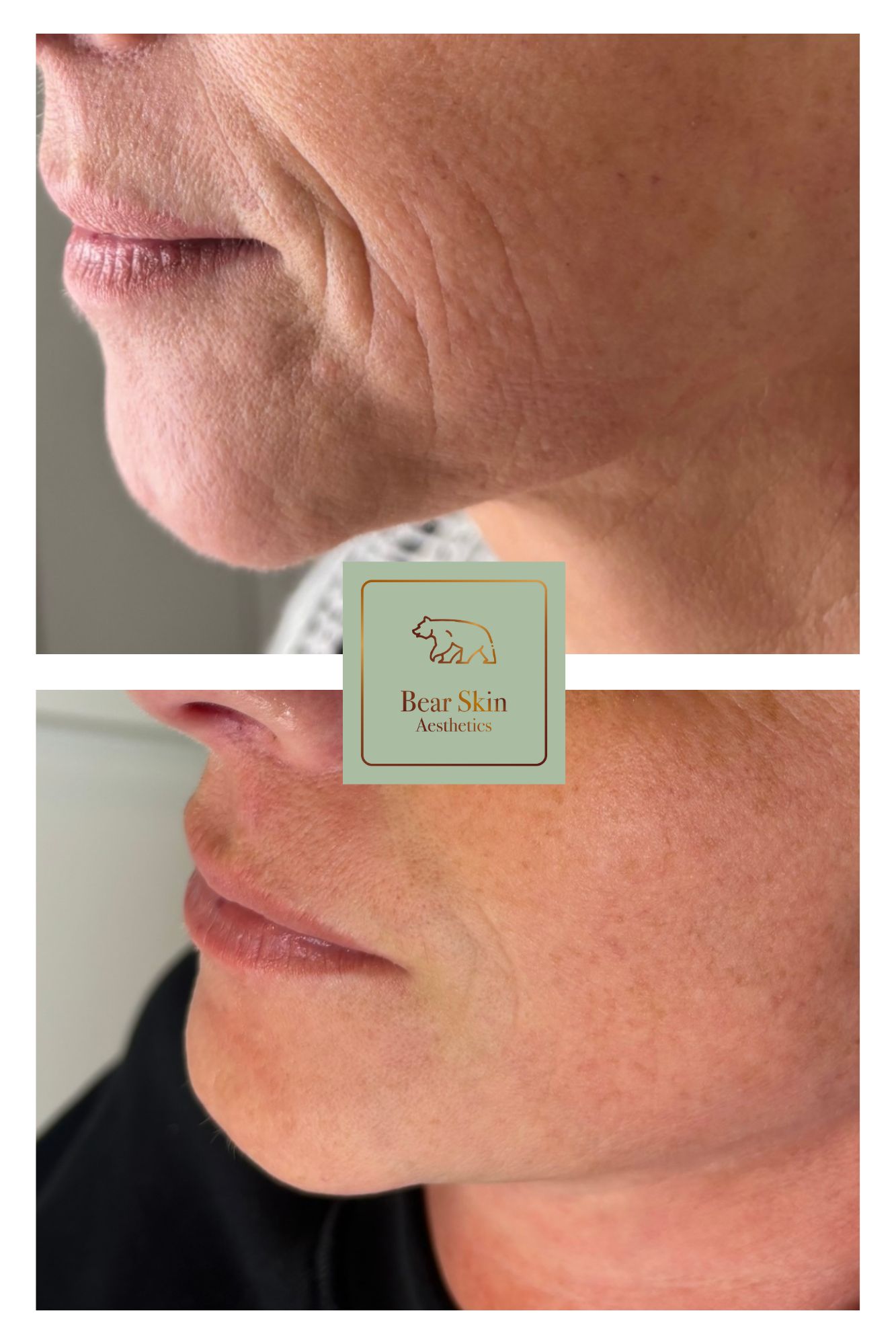 Before and after — Jawline tightening
