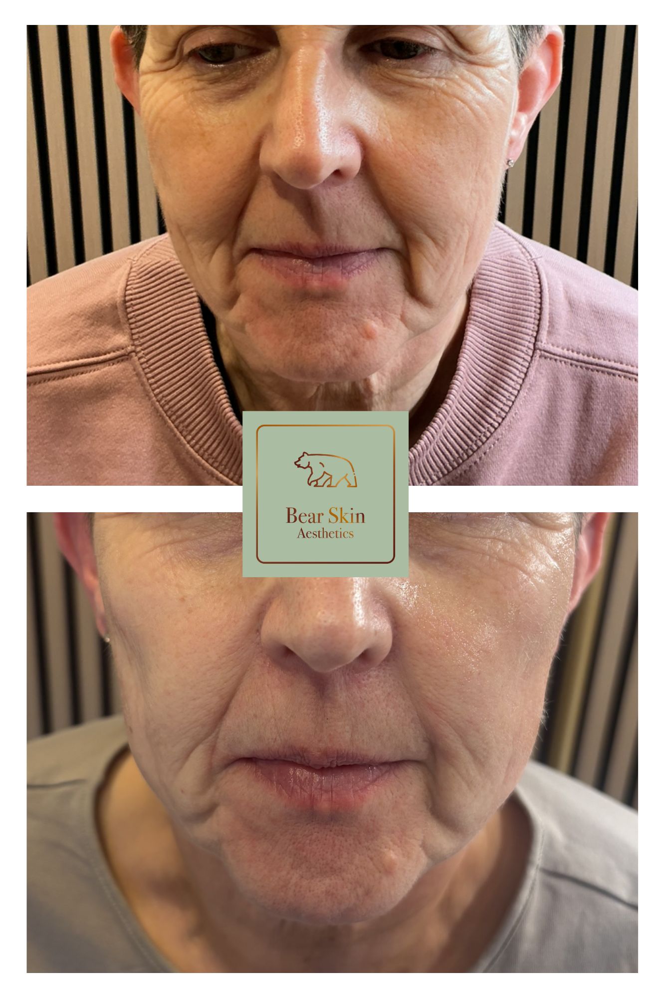 Before and after — Skin smoothing