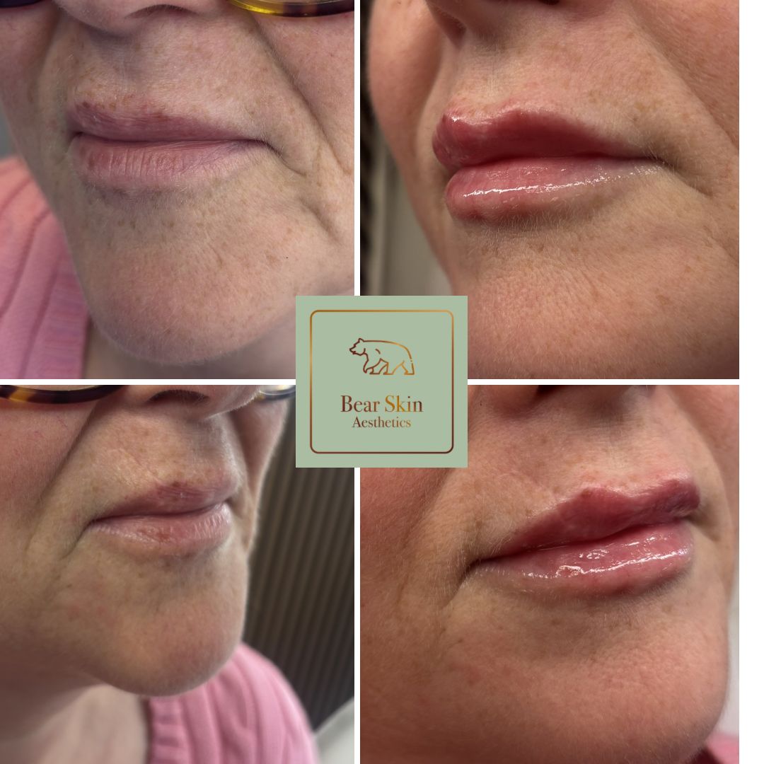 Before and after — Refined lip contour