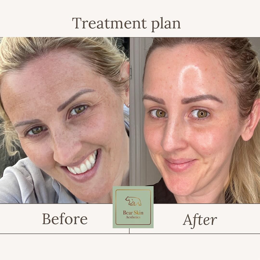 Before and after a Bear Skin Aesthetics treatment plan