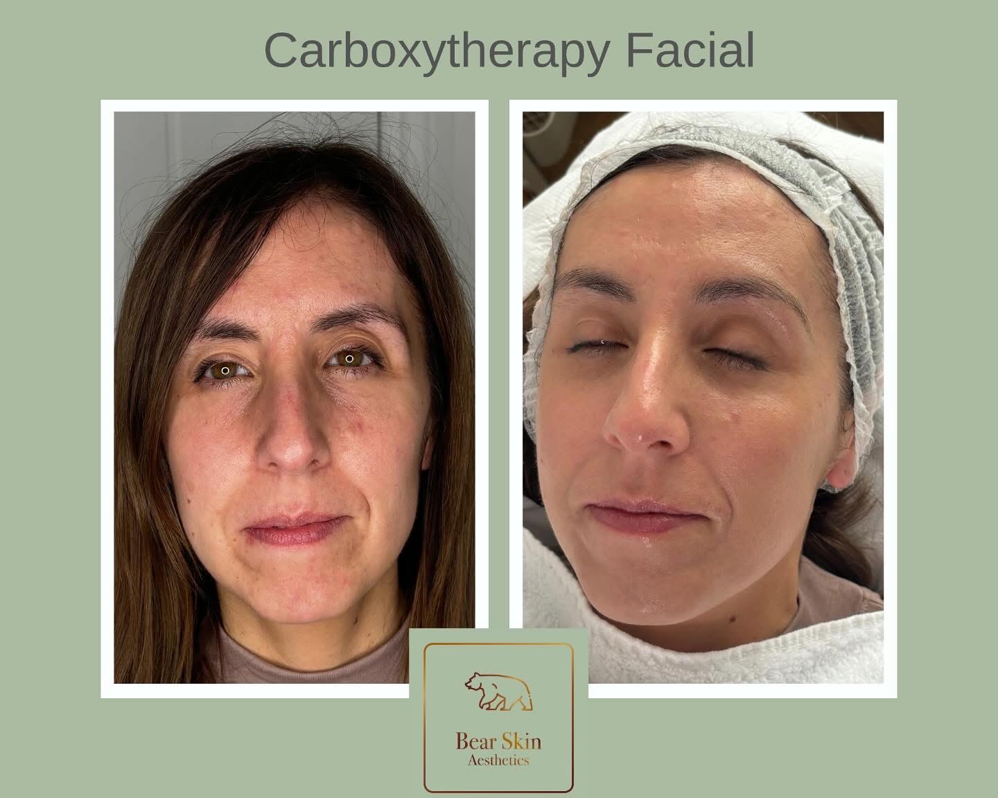 Before and after — Carboxytherapy facial