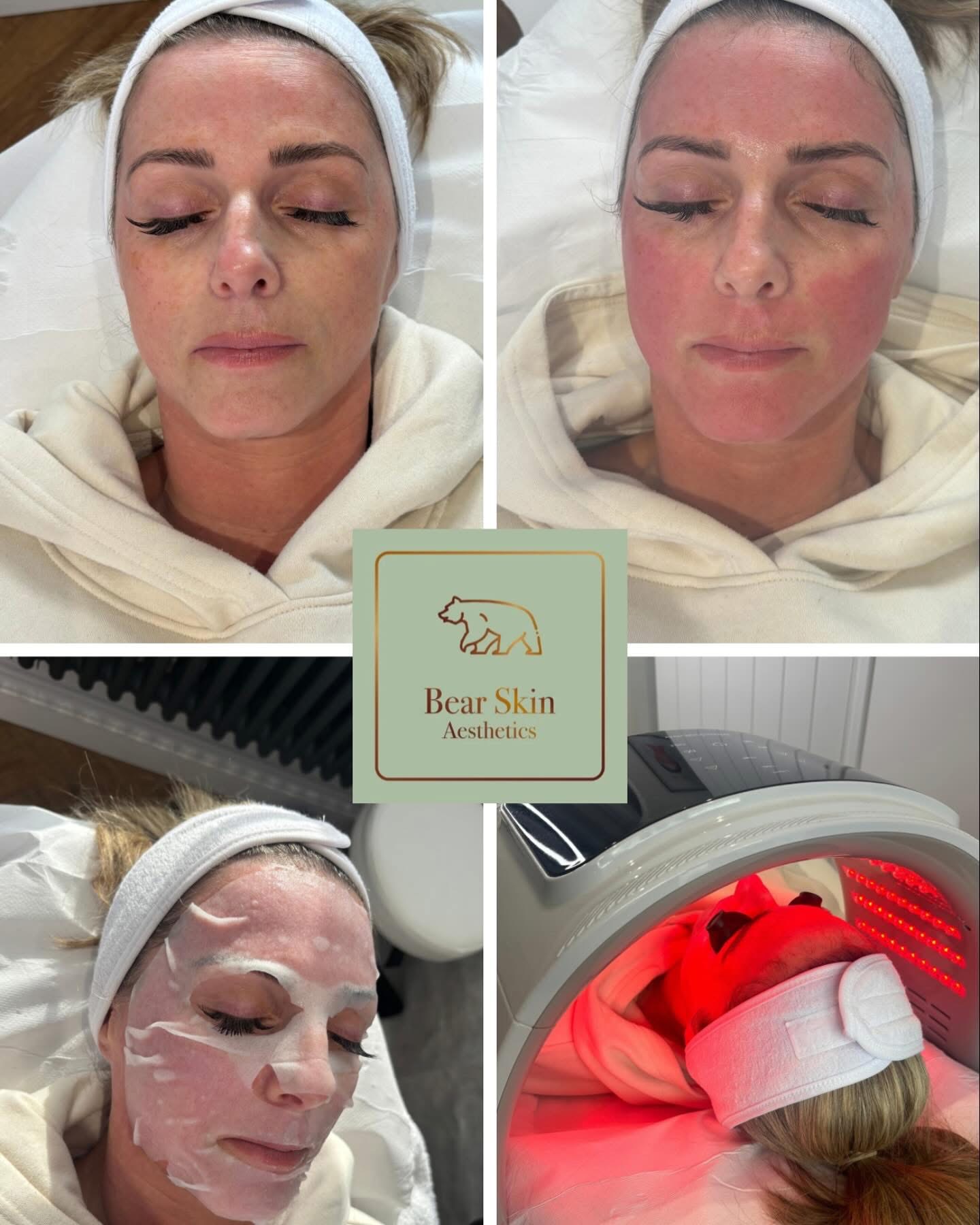 Before and after — Glow facial