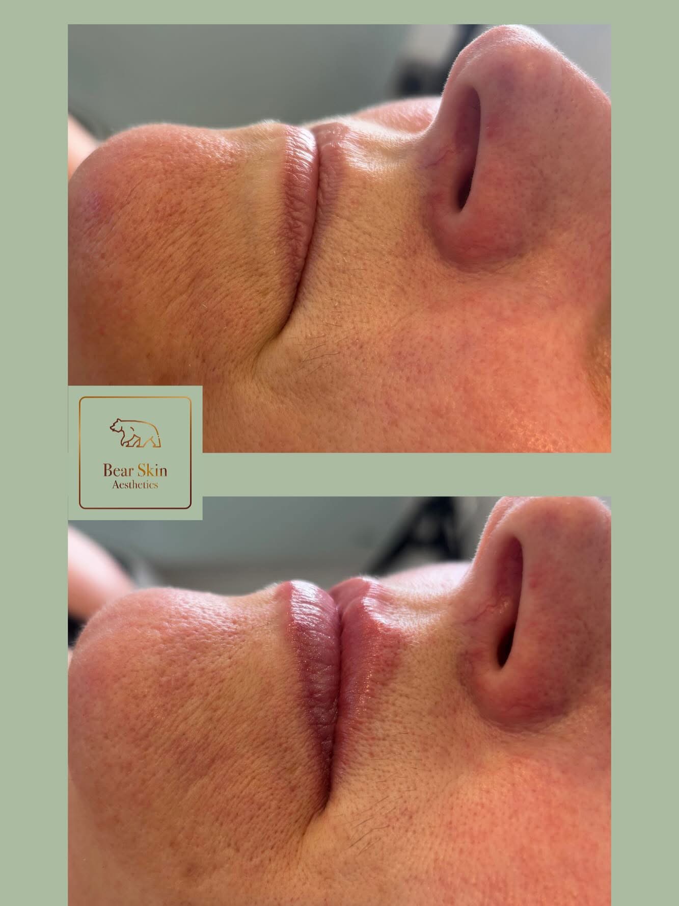 Before and after — Subtle lip definition