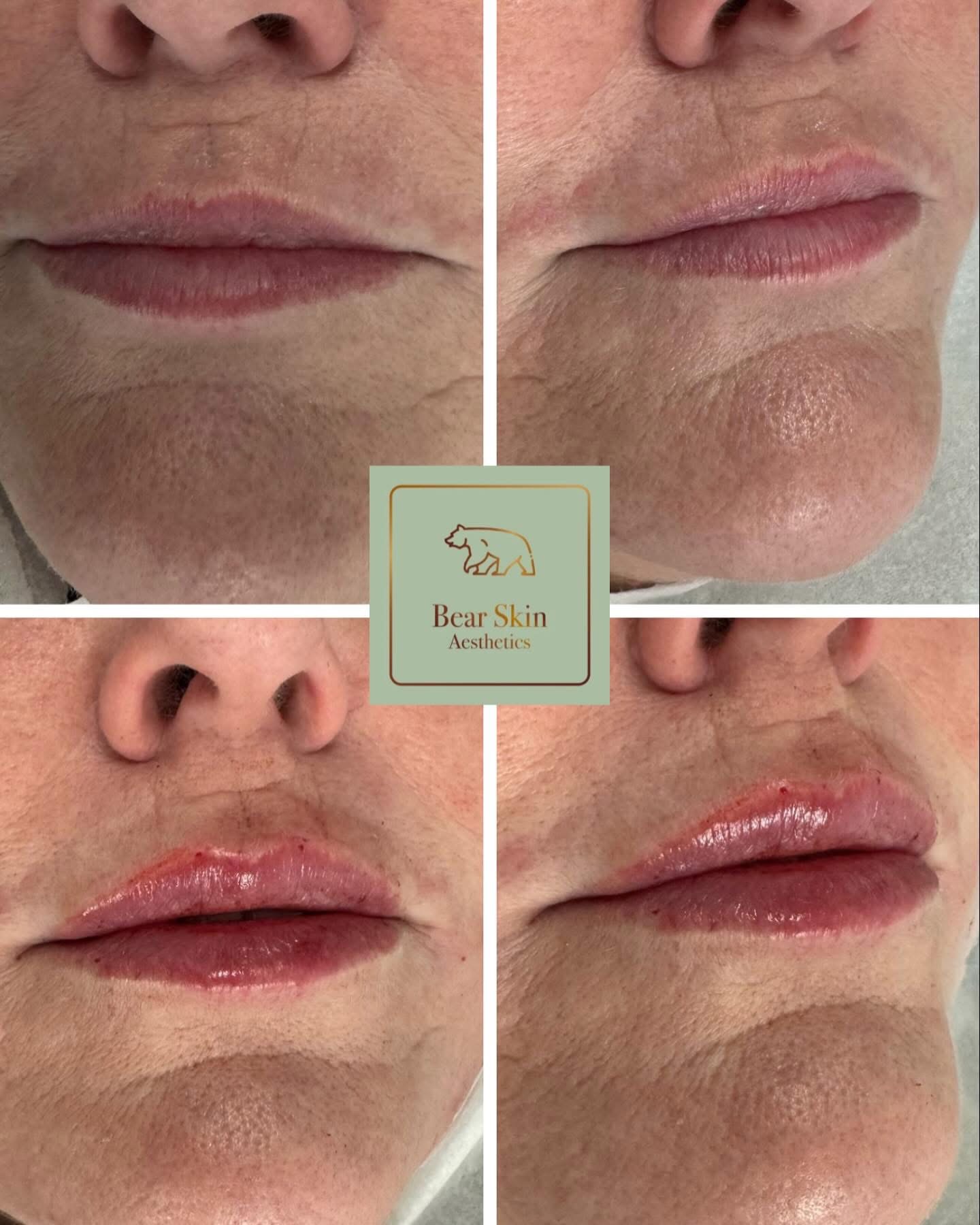 Before and after — Lip enhancement
