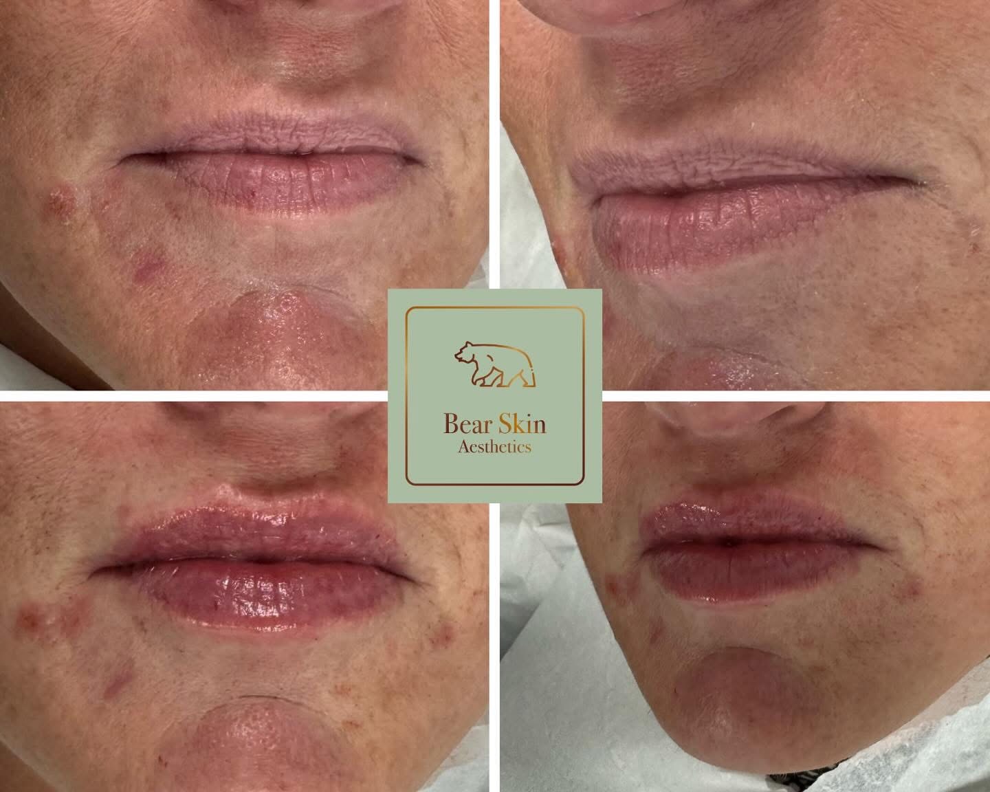 Before and after — Lip rejuvenation