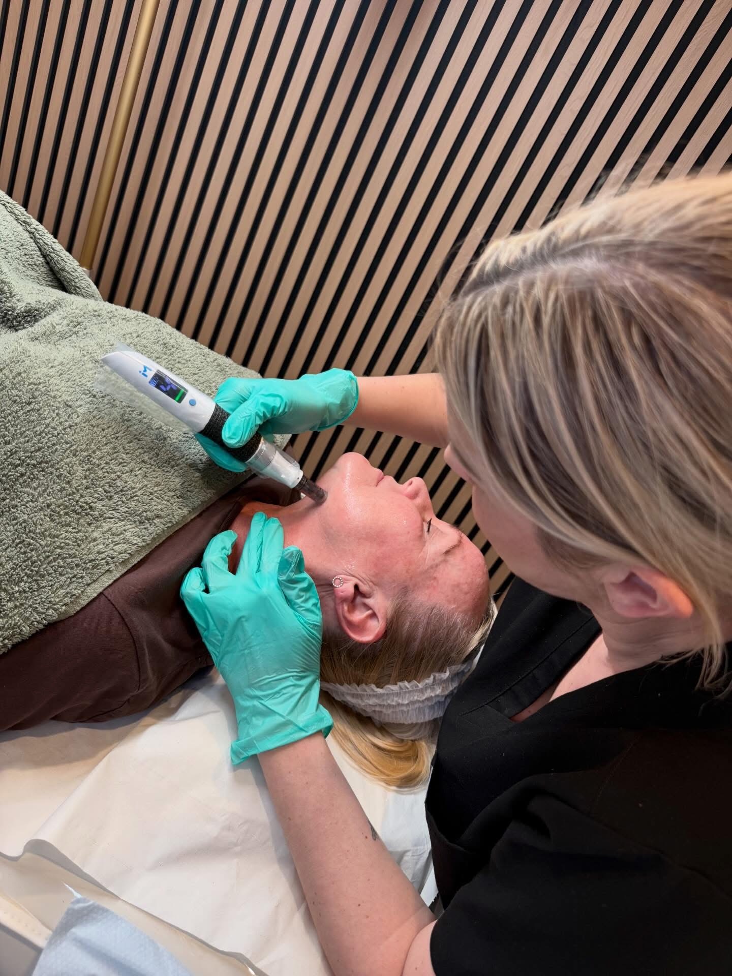 Microneedling